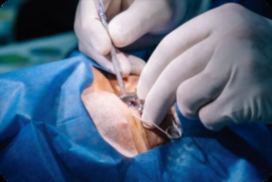 Cataract Surgery
